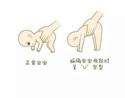 孩子患腦癱日常飲食要注意的事項有哪些方面