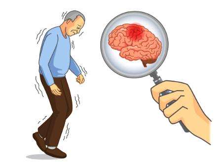 經(jīng)顱磁_(tái)帕金森病的早期癥狀有哪些 