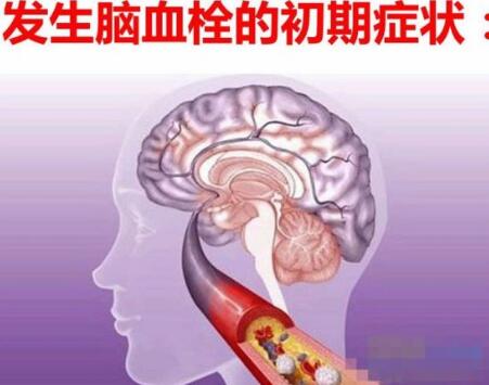 經(jīng)顱磁刺激儀家用的_腦血栓復(fù)發(fā)的誘因有哪些 