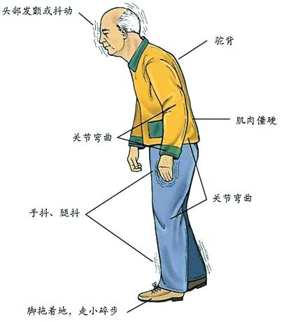 經顱磁刺激常見問題_帕金森的典型癥狀是什么