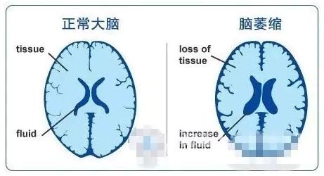 擇思達(dá)斯經(jīng)顱磁刺激儀_老年人腦萎縮什么癥狀